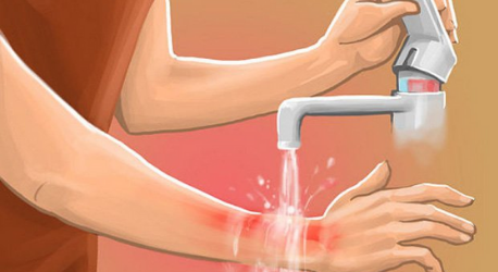 Cách chữa bỏng nhanh chóng từ 6 nguyên liệu cơ bản nhất!